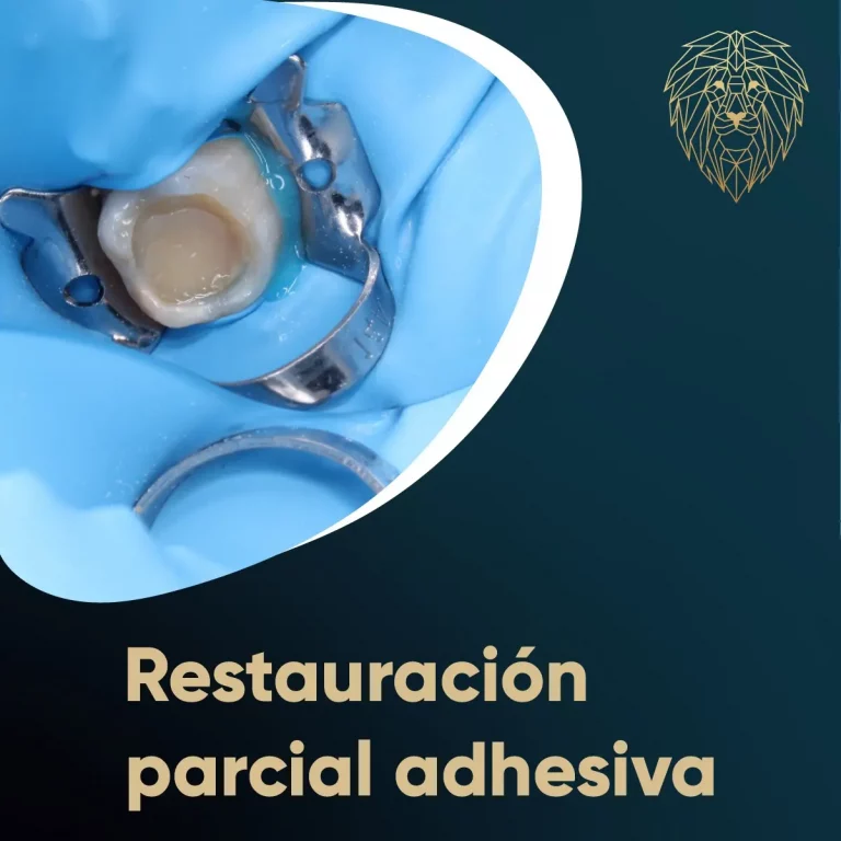 Restauración parcial adhesiva