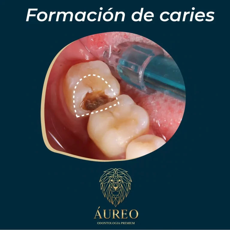 formacion-de-caries