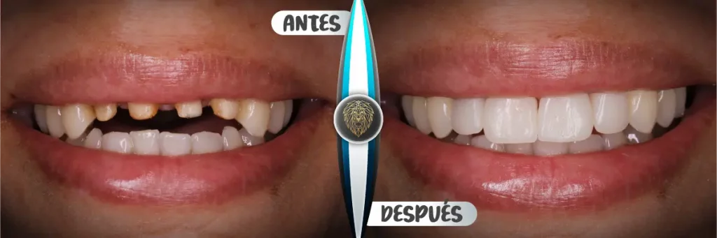 importancia del diseño de sonrisas