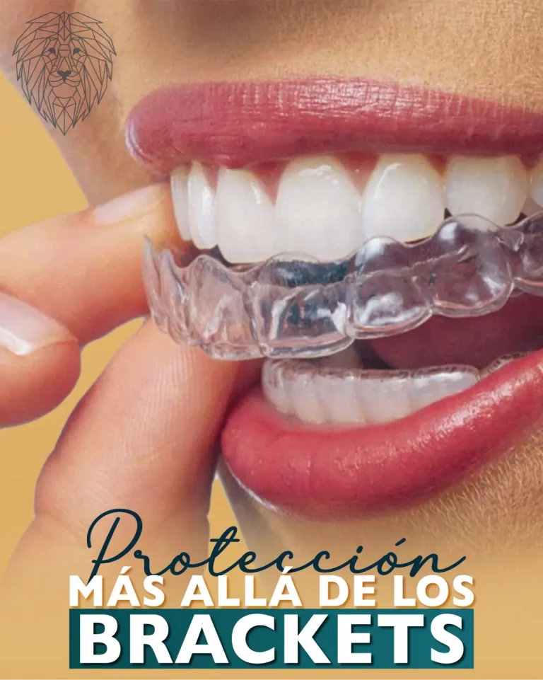 ortodoncia invisible: proteccion mas alla de los brackets blog