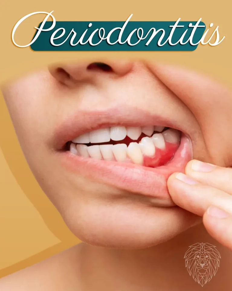 descubre la periodontitis post