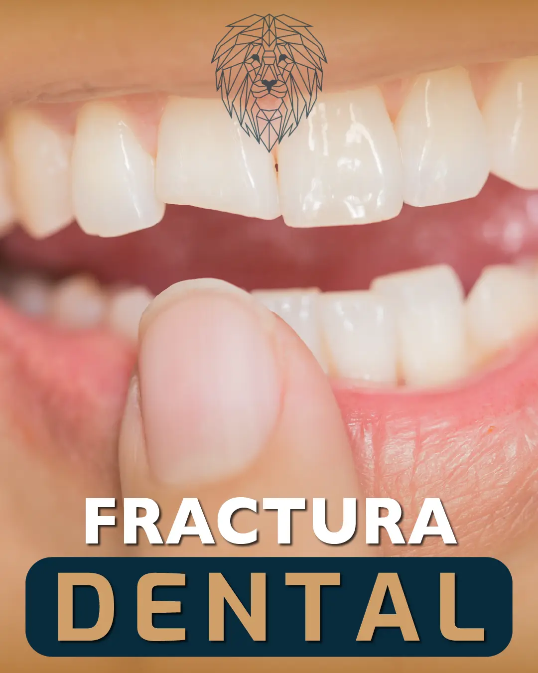 Fractura Dental: Pasos Esenciales para un Tratamiento Inmediato