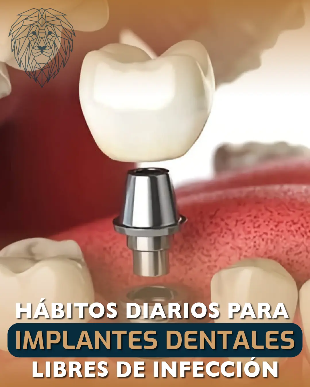 Hábitos Diarios para Implantes Dentales Libres de Infecciones